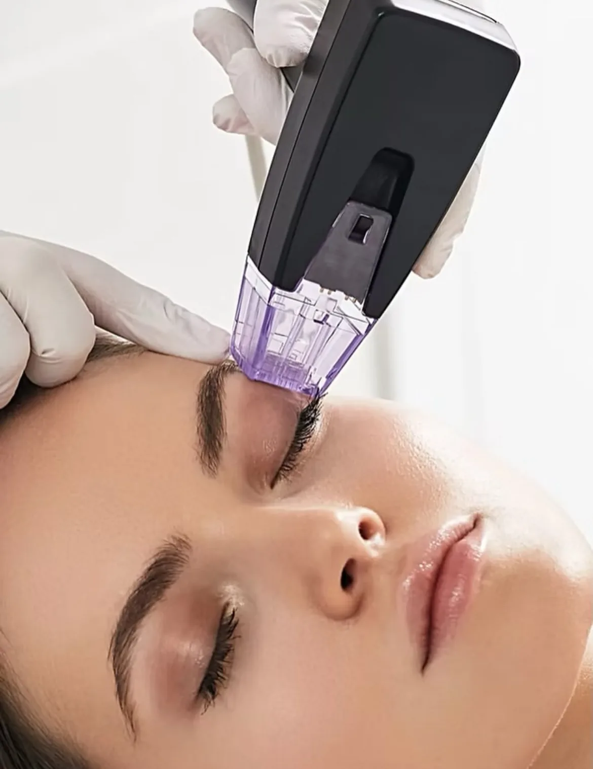 Microneedling treatment at Glam & Glow